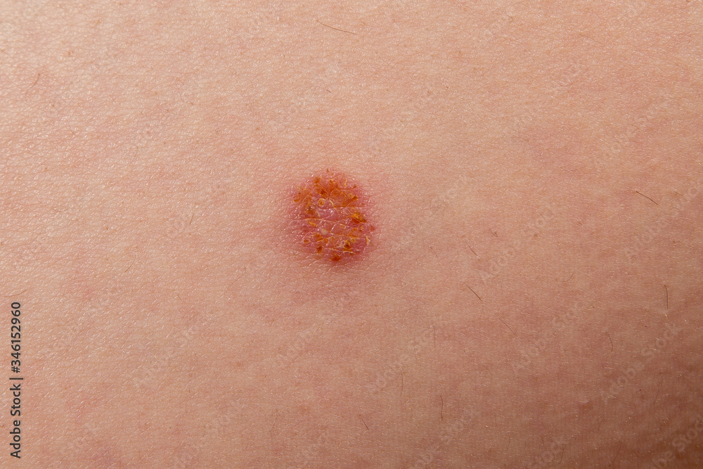 Fototapeta premium inflammation of the skin, the use of ointments for treatment