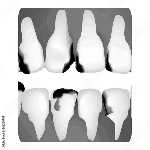 Dental caries. X-ray of tooth decay. Caries infographics. Vector illustration on isolated background.