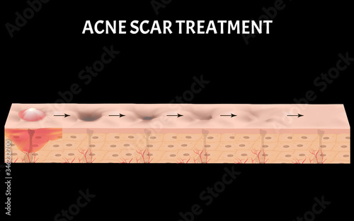 Atrophic scars. Acne scar. The anatomical structure of the skin with acne. Vector illustration.