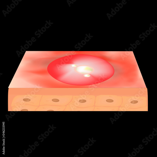Cyst acne. furuncle Acne on the skin cysts and pimples. Dermatological and cosmetic inflammatory diseases on the skin of the face. Infographics. Vector illustration on isolated background.