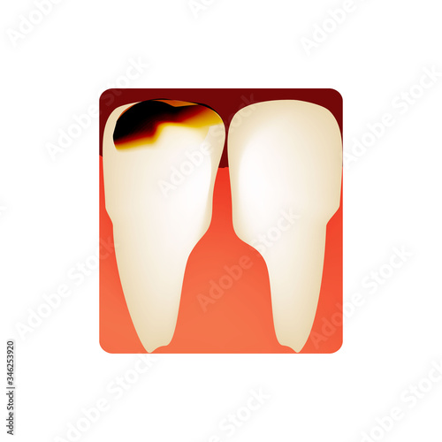 Dental caries. tooth decay. Caries infographics. Vector illustration on isolated background.