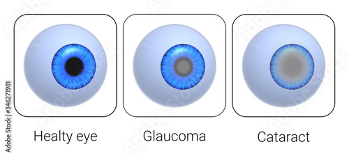 Healthy eye, glaucoma, cataract. Eye deseases. Isolated on white. 3D-rendering. 