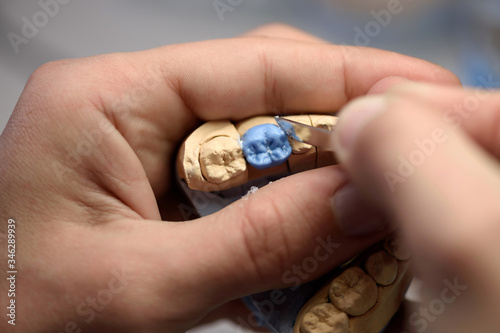 Dental technician modeling wax prosthesis model using dental modeling knife. Closeup of hands.