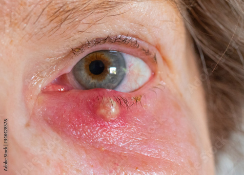 Gerstenkorn am Auge