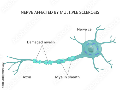 Multiple Sclerosis Failure Myelin Cells Autoimmune Disease