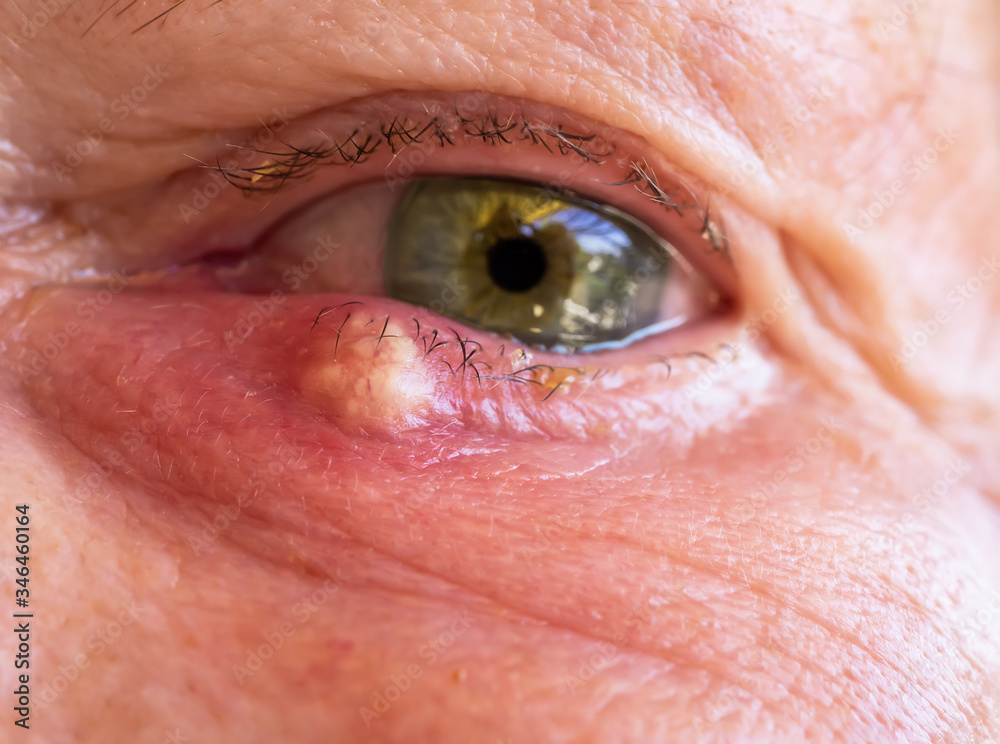 Stye or hordeolum and blepharitis in right lower eyelid of a woman. It