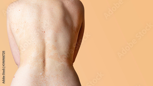 Allergic dermatitis on the skin of a woman's back. Skin disease. Neurodermatitis disease, eczema or allergy rash. Healthcare and Medical. Desquamation of the skin. Banner, copy space for text