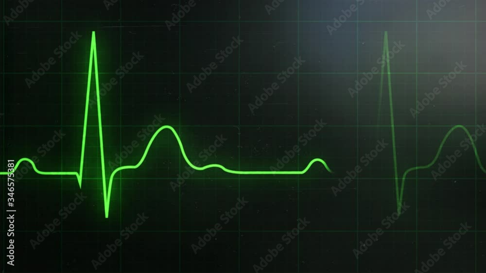 Loop EKG Heart Rate In Normal Sinus Rhythm. Green Beat Line On The Monitor. Graph Of Electrical Activity Related To The Cardiac Contractions And Grid Scale With Axes For The Interpretation Of ECG Wave Loop EKG Heart Rate In Normal Sinus Rhythm. Green Beat Line On The Monitor. Graph Of Electrical Activity Related To The Cardiac Contractions And Grid Scale With Axes For The Interpretation Of ECG Wave