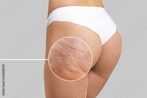 Young woman with cellulite problem on light background