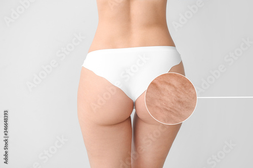 Young woman with cellulite ...