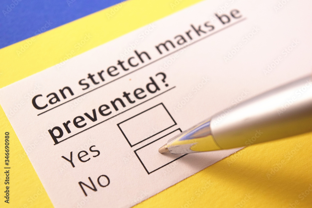 Can stretch marks be prevented? Yes or no? Can stretch marks be prevented? Yes or no?