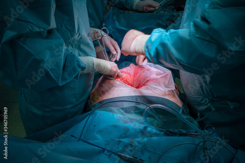 a surgical team performs a surgical abdominal operation