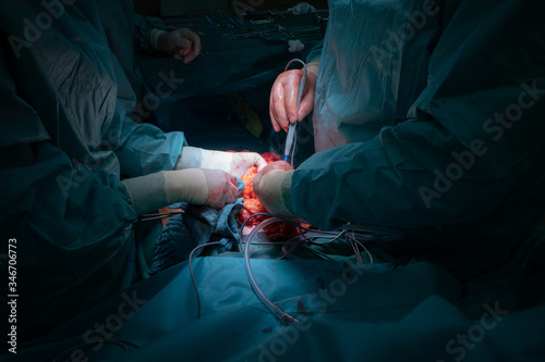 a surgical team performs a surgical abdominal operation