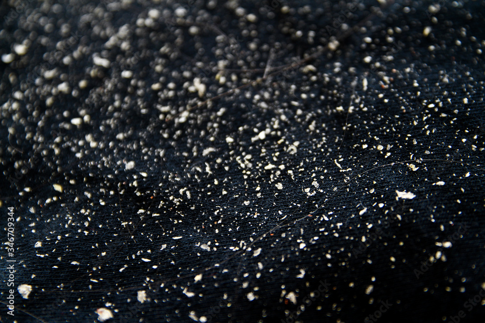 Dandruff on black shirt Dandruff on black shirt