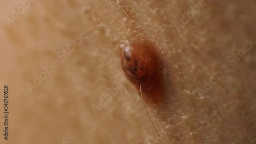 Mole nevus on the neck of a person, macro. Papilloma on the skin, dermatology photo