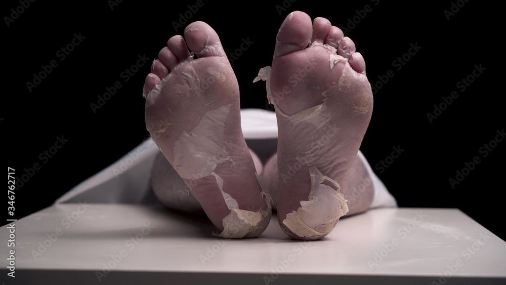 Fototapeta premium Pathologist in black gloves hangs blank white tag on foot of corpse. legs of girl or guy who died from illness are in morgue under white blanket. Dry pilled skin on the feet.