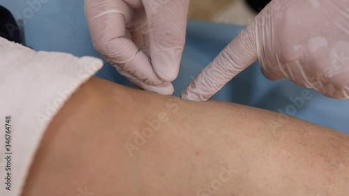 Chinese doctor doing acupuncture on the knee to a patient