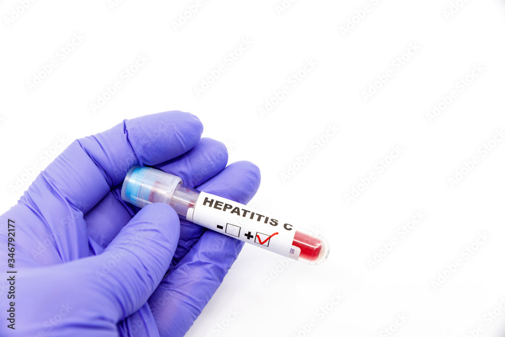 Naklejka premium Closeup of microbiologist or medical worker hand with blue surgical gloves marking blood test result as positive for the hepatitis C. Hepatitis C Positive concept