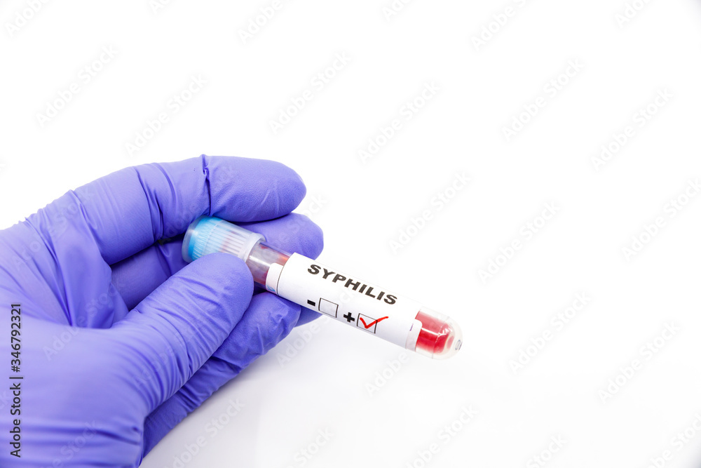 Fototapeta premium Closeup of microbiologist or medical worker hand with blue surgical gloves marking blood test result as positive for the syphilis. Syphilis Positive concept