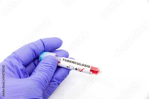 Closeup of microbiologist or medical worker hand with blue surgical gloves marking blood test result as positive for the tuberculosis. Tuberculosis Positive concept