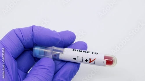 Closeup of microbiologist or medical worker hand with blue surgical gloves marking blood test result as positive for the rickets. Rickets Positive concept
