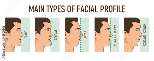 Main types of facial profile - convex, concave, plane.