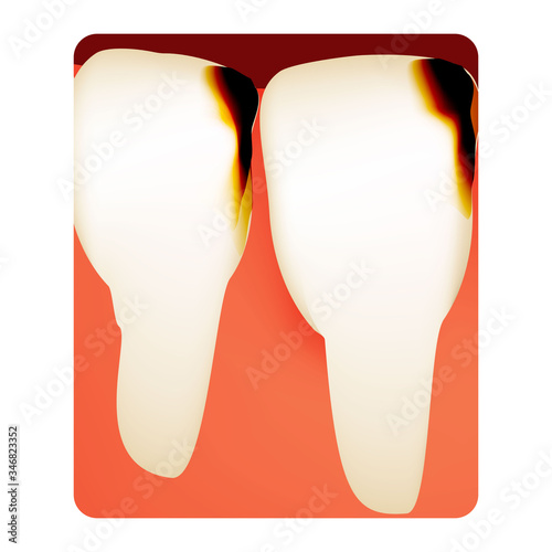 Dental caries. tooth decay. Caries infographics. Vector illustration on isolated background.