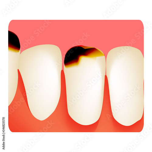 Dental caries. tooth decay. Caries infographics. Vector illustration on isolated background.