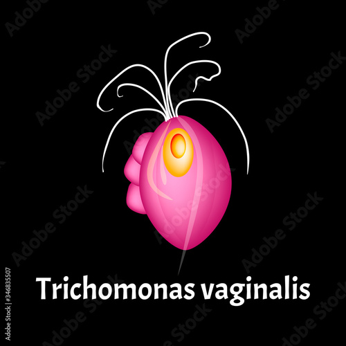 Trichomonas vaginal. Infographics. Vector illustration on isolated background. photo