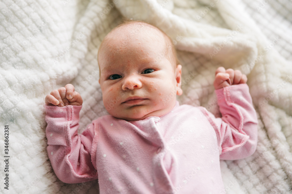 Baby Acne Small Red And Purulent Inflammations On The Skin Of The Face