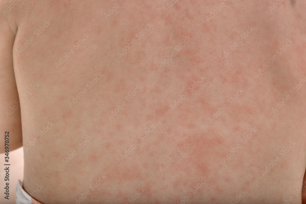 roseola-rash-a-viral-rash-on-the-skin-of-a-child-stock-foto-adobe-stock