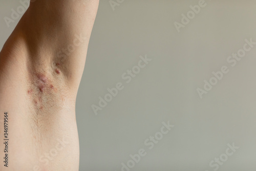 A patient diagnosed with Crohn’s disease with hidradenitis suppurativa under his armit with visible red painful fistulas. Irritated skin and hair follicles, abcess. Close up photo