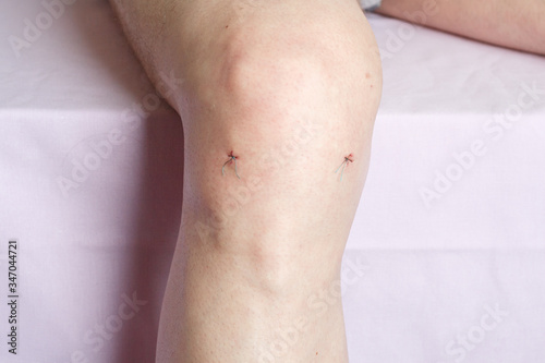 Arthroscopy or arthroscopic meniscectomy surgical suture of a man's knee in the hospital
 photo