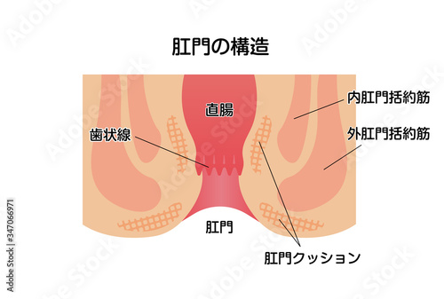 痔のタイプ・種類 (肛門断面図イラスト)