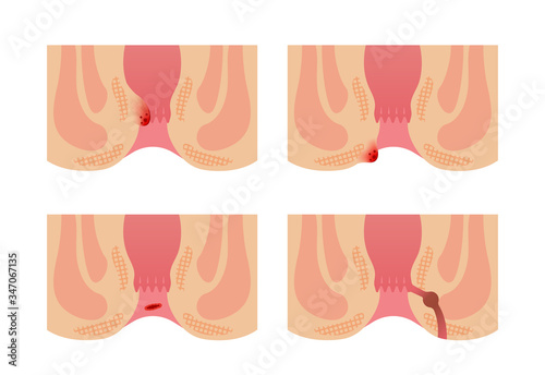 Types of Hemorrhoid flat vector illustration (no text)