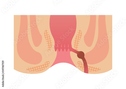 Photographie Type of Hemorrhoid flat vector illustration / anal fistula
