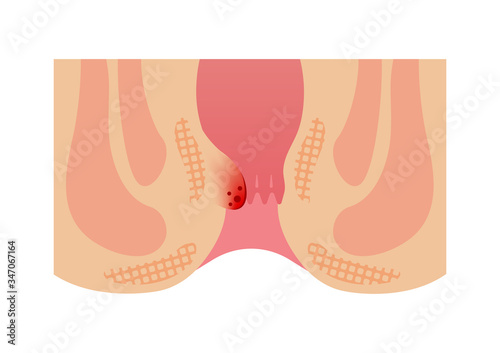 Type of Hemorrhoid flat vector illustration / Internal hemorrhoid