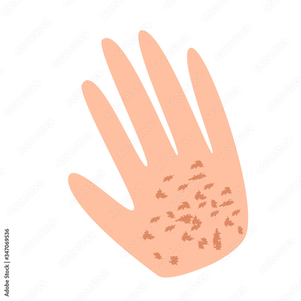 Freckles on the hand. Pigmentation on the skin. A pigmented spot on the skin of the hand. Vector illustration Freckles on the hand. Pigmentation on the skin. A pigmented spot on the skin of the hand. Vector illustration