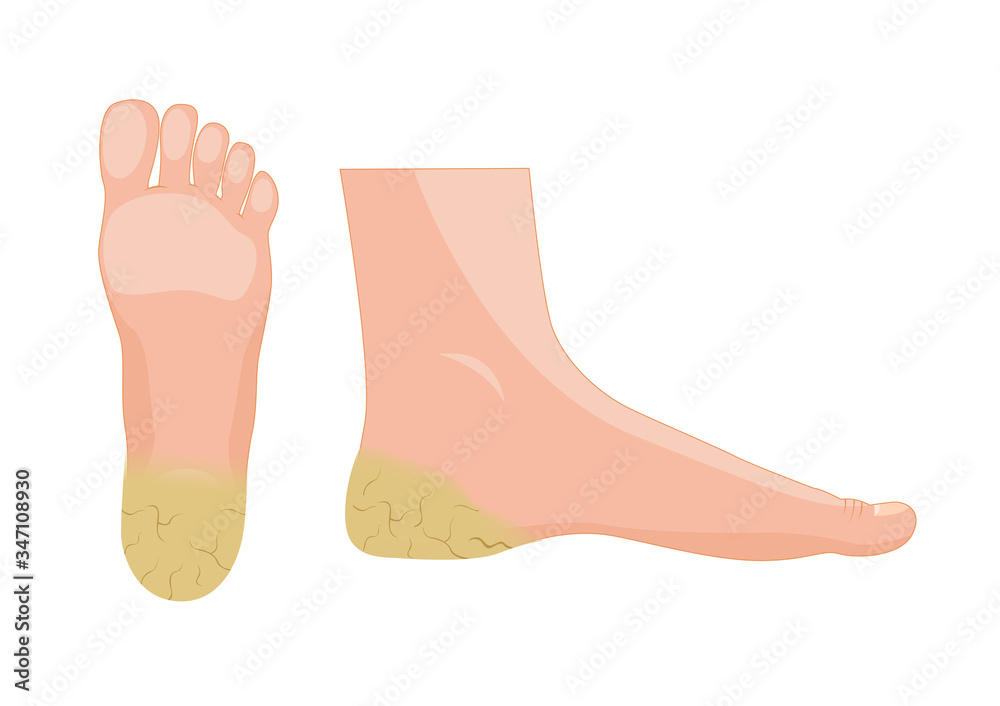 Plantar Hyperkeratosis vector / human anatomy Stock Vector | Adobe Stock