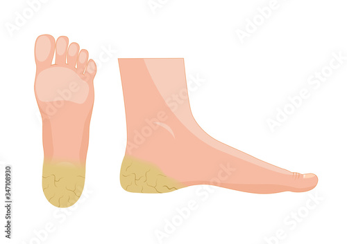 Plantar Hyperkeratosis vector / human anatomy