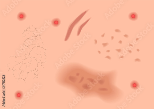 pus acne pimple freckle chloasma burn aging dry  and ringworm vector