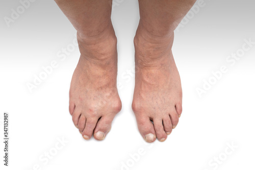 Varus valgus and Hallux valgus, bunion on white background.