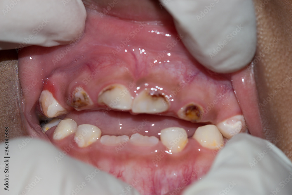 dental caries in a child