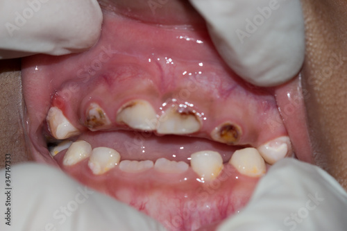 dental caries in a child