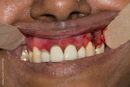 close up of gingivitis