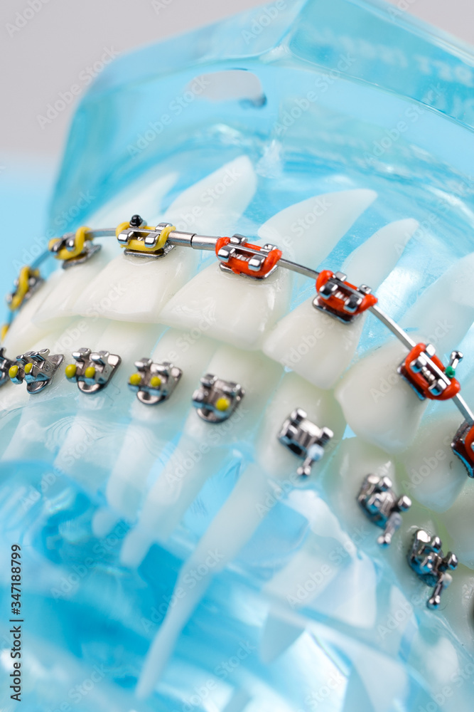 Aggregate 143+ o ring orthodontics netgroup.edu.vn