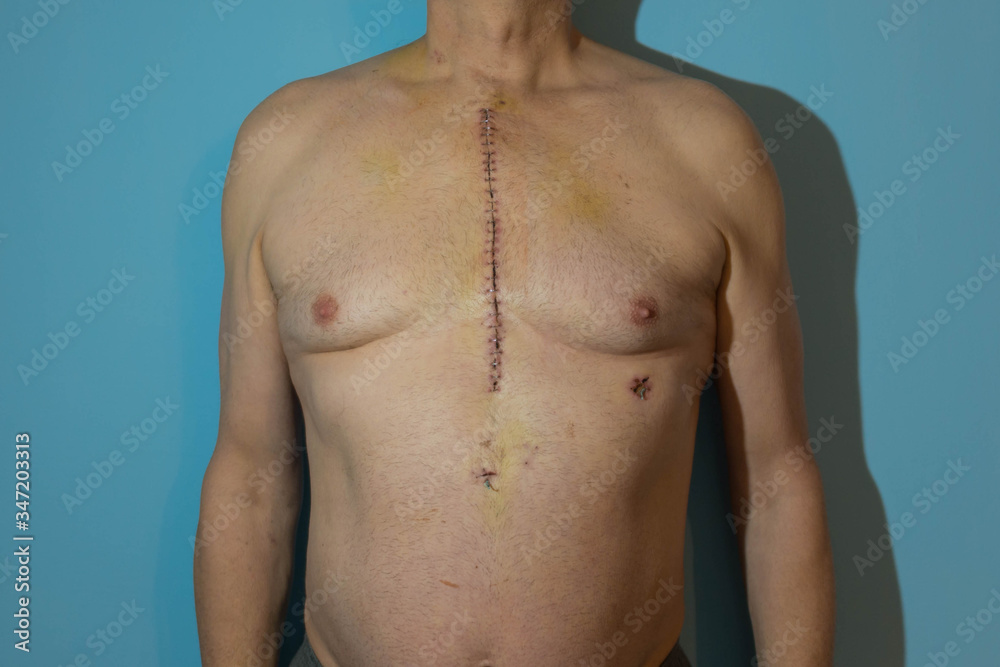 Klatka piersiowa mężczyzny po operacji bypass. - obrazy, fototapety, plakaty 