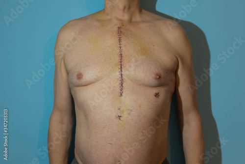 Klatka piersiowa mężczyzny po operacji bypass.