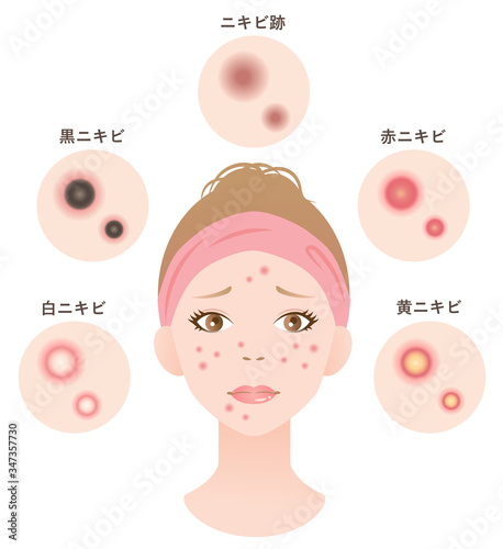 ニキビの種類　女性　美容