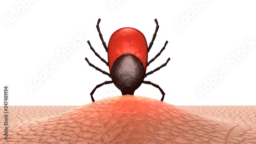 Female tick embedded in human skin. 3D-rendering. 